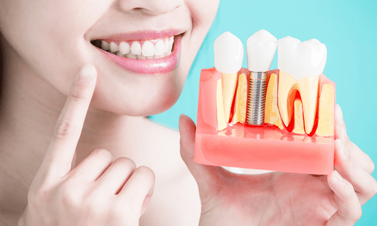 Aprenda como conseguir implante dentário de graça pelo programa Brasil Sorridente